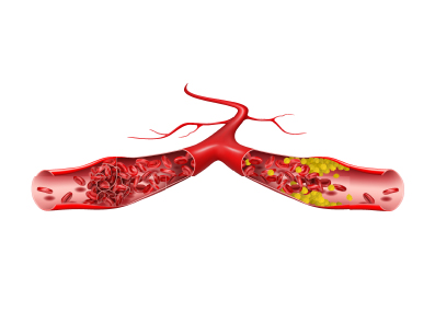 Φλεβική Θρόμβωση